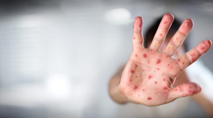 Crește numărul cazurilor de rujeolă în Chișinău