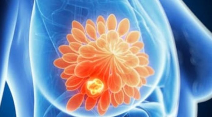 Spania investighează un cancer rar asociat implanturilor mamare: peste 100 de cazuri raportate
