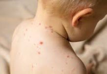 Atenționare medicală după un deces: varicela nu este o boală banală